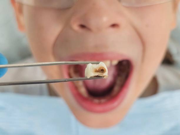 Best Emergency Broken Tooth Repair in Endicott, NY